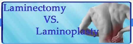 Laminectomy vs. Laminoplasty Surgery